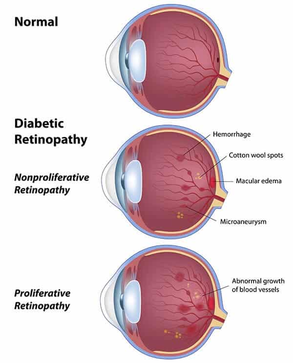 Chart Illustrating a normal eye compared to one experiencing diabetic retinopathy