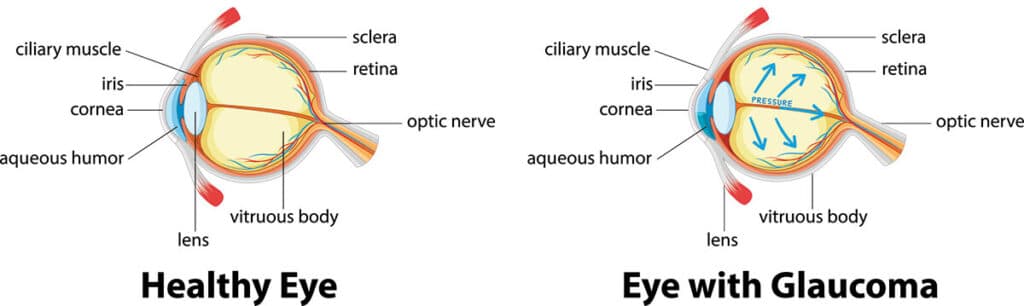 Chart Illustrating a healthy eye compared to one experiencing glaucoma
