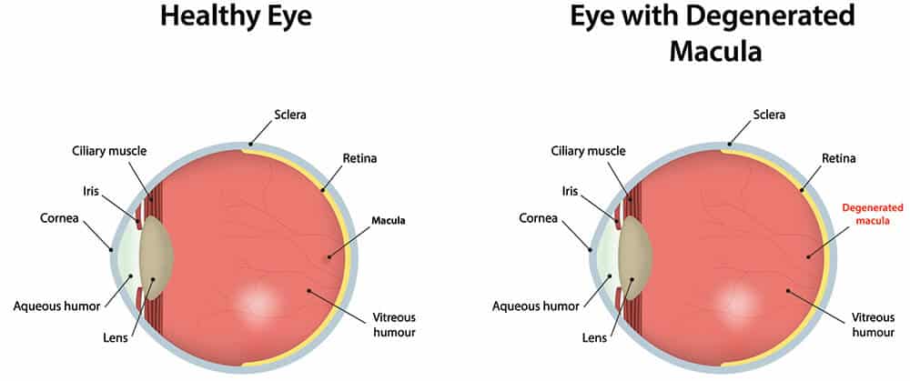 Chart Illustrating a healthy eye compared to an eye with a degenerated macula